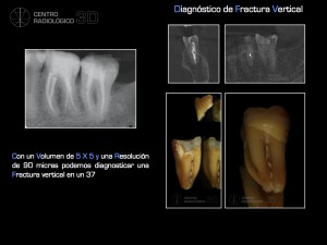 Manuel Ruiz. Diagnostico Fractura vertical. Carestream 5 x 5.024